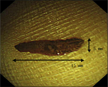 The hepatic fluke was 15 mm × 3 mm in size, with brown pigmented, leaf-shaped ...