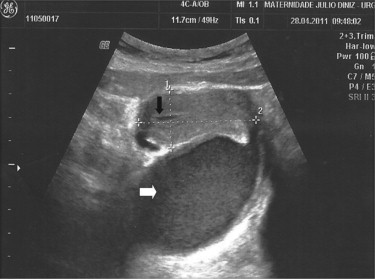 Ecografia pélvica (seta branca: dilatação da vagina, hematocolpos; seta preta: ...