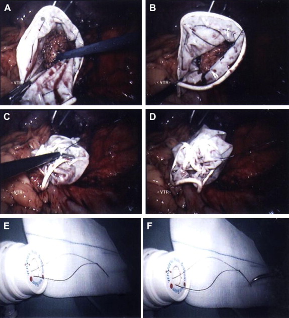 (A, B) We used laparoscopic instruments to open the homemade retrieval bag and ...