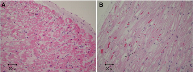 Representative routinely stained atrial tissue sections from patients with A. ...