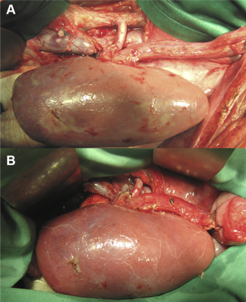 Implanted kidney after reperfusion. (A) The arterial and venous anastomosis are ...