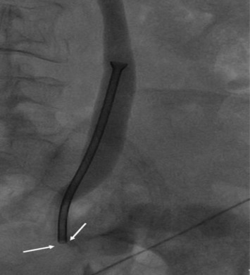Right nephrostogram showing a Memokath 051 stent in a dilated ureter. The distal ...