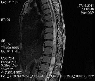 Sagittal T2-weighted magnetic resonance imaging between T12 and L1 demonstrates ...