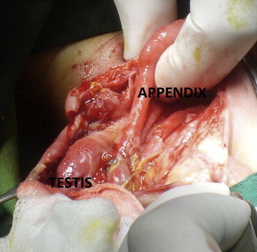 Perforated appendix in the inflamed scrotum.