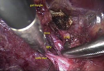 Laparoscopic view of hepatic hilum dissection. CHD = common hepatic duct; ...