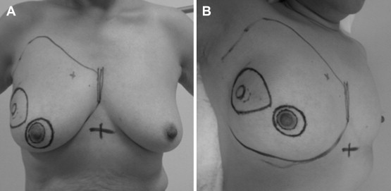 Preoperative drawings in a patient who underwent MRBT (Table 1, Case 6), with ...