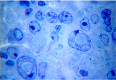 Deformation of tumour cells' nuclei 20days after five-fold injection of lithium ...