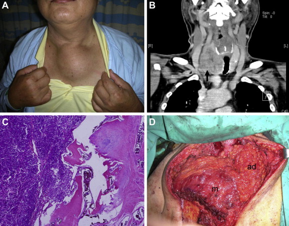 (A) A 56-year-old male patient presenting with a painful enlarged mass over his ...