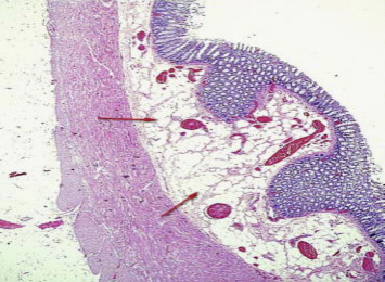Histopathology of the resected sigmoid colon of a patient with Ehlers–Danlos ...