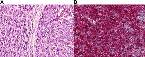 Histopathological images of the esophageal tumor: (A) diffuse sheets of spindle ...