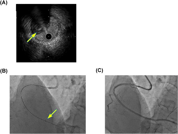 (A) Presence of guidewire in true-lumen revealed by intravascular ultrasound ...