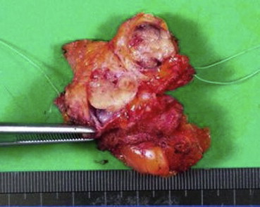 The cystic lesion and dilated mammary duct were fully removed, and could be seen ...