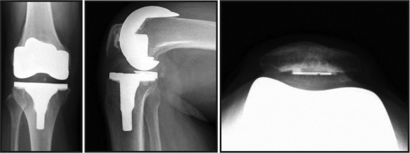 The high-flex insert of the Genesis II, a total knee arthroplasty (TKA) implant ...
