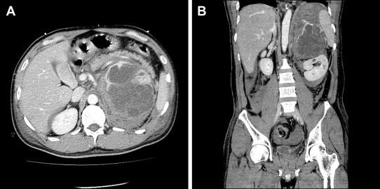 Preoperative computed tomography findings showed the left adrenal lesion with ...