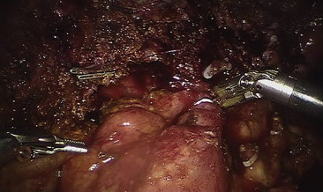 Intraoperative view of hepaticojejunostomy to be revised.