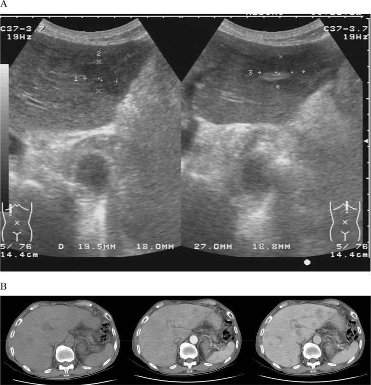 (A) Abdominal ultrasonography of the liver (left: right lateral lobe; right: ...