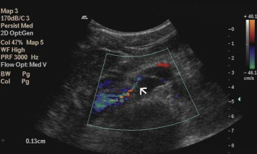 Doppler ultrasound showing nutcracker phenomenon. Narrowing aortomesenteric ...