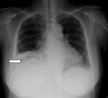 Erect chest X-ray on admission: lucency below the right diaphragm.