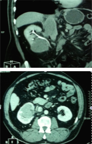 TC abdominal mostrando lesão sólida com 67x65mm, na metade inferior do rim ...