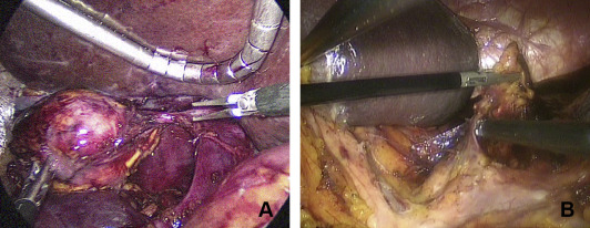 An intracorporeal view of dual incision laparoscopic adrenalectomy (A) right; ...