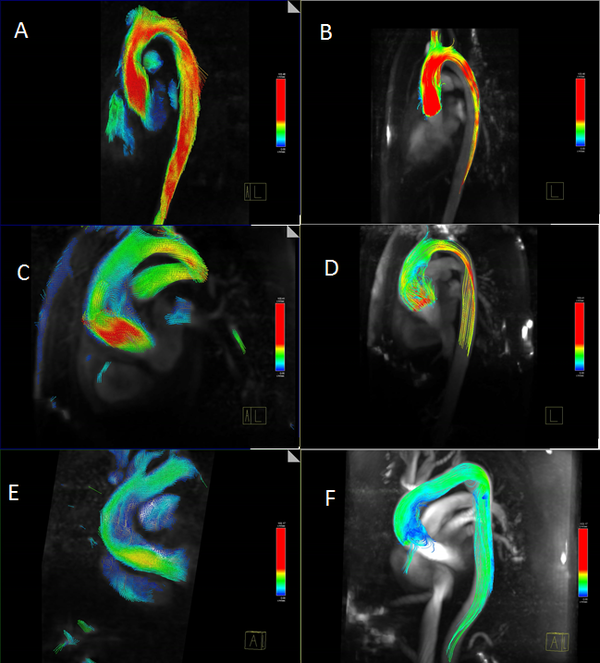Blood flow patterns in ascending aorta, left (velocity vector), right (streamlines). A and B show a laminar flow with maximum speed in the center of the aortic flow. C and D show a turbulent flow into the dilation of the aorta with an eccentric jet. D and E show a turbulent flow into the elongation of the aorta with an eccentric jet.