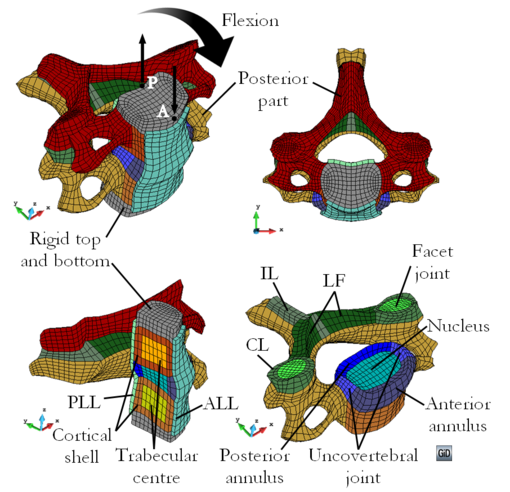 \mathrmC₄–\mathrmC₅  FSU meshed with Q1P0 elements. The components of the model   and loading for flexion are detailed in the image. To impose extension loading, the flexion loading is reversed.