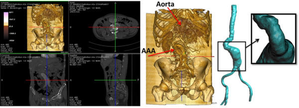 Left CT DICOM (sagital, coronal and axial images) of patient with Aortic Abdominal Aneurysm. Center CT volume render of Aortic Abdominal Aneurysm illustrating the Abdominal sac. Right computational patient-specific model and computational mesh