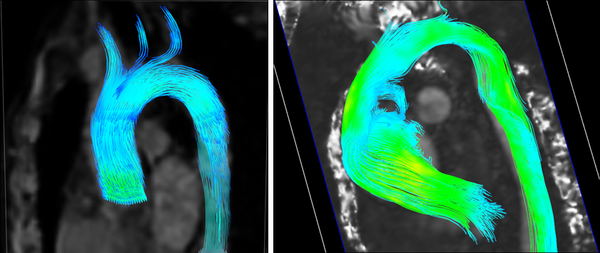 Left: Streamlines in a healthy aorta. Right: Streamlines in unhealthy aorta