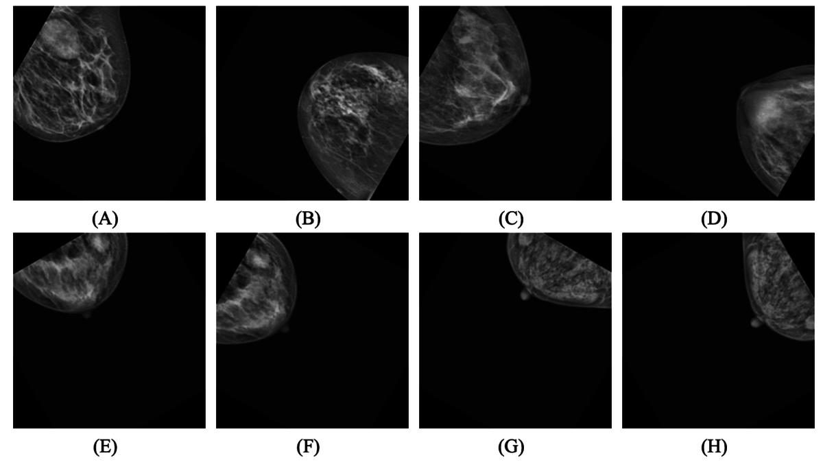 Early detection of breast cancer in mammograms using the lightweight ...