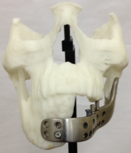 New half lower jaw prosthesis presented into the model.