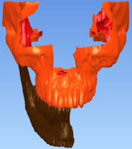 Mandibular resection.\label{F3a}