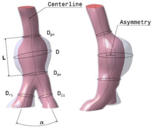 Abdominal Aneuryms 1D geometrical parameters. D: maximum transverse diameter, Dₚₙ: neck proximal diameter(smallest diameter of the infrarenal artery, just before the AAA), Ddn: neck distal diameter (smallest diameter of the aorta, just after the AAA), L: aneurismal length (length between proximal and distal necks), Dli: left iliac diameter (left iliac diameter), Dri: right iliac diameter (right iliac diameter) and α is the angle between the right and left iliac arteries.