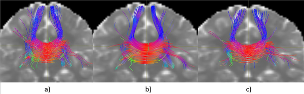 Comparación visual de tractografías generadas desde una semilla en el cuerpo calloso: a) iFOD2, b) SD-Stream, c) Algoritmo propuesto.